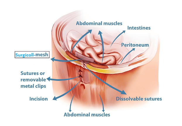 Abdominal hernia repair placement detail